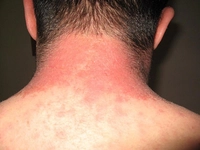 Vücutta Kabarma Belirtileri ve Tedavisi Vücutta Kabarma Belirtileri ve Tedavisi